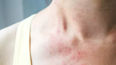 5 Tips to prevent rashes during weather change