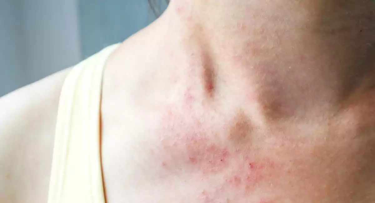 5 Tips to prevent rashes during weather change